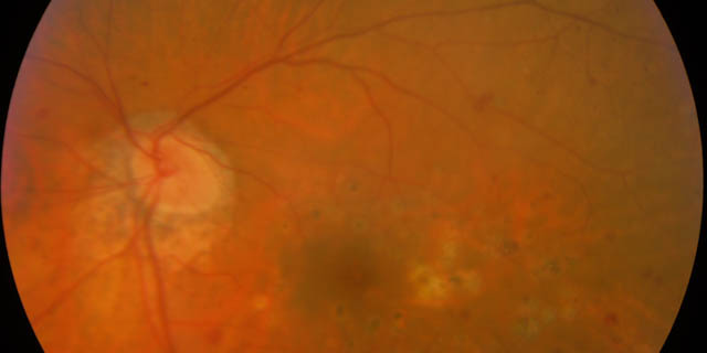 Retinopatia Diabetica